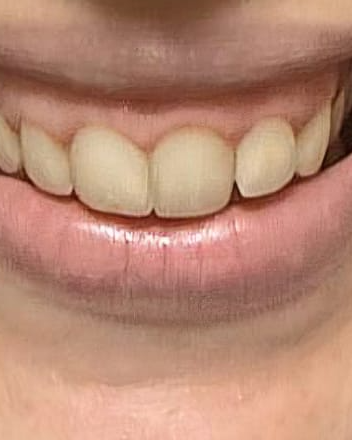 Antes — botox para sorriso gengival